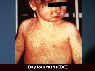 Young boy with measles. (U.S. Centers for Disease Control and Prevention)