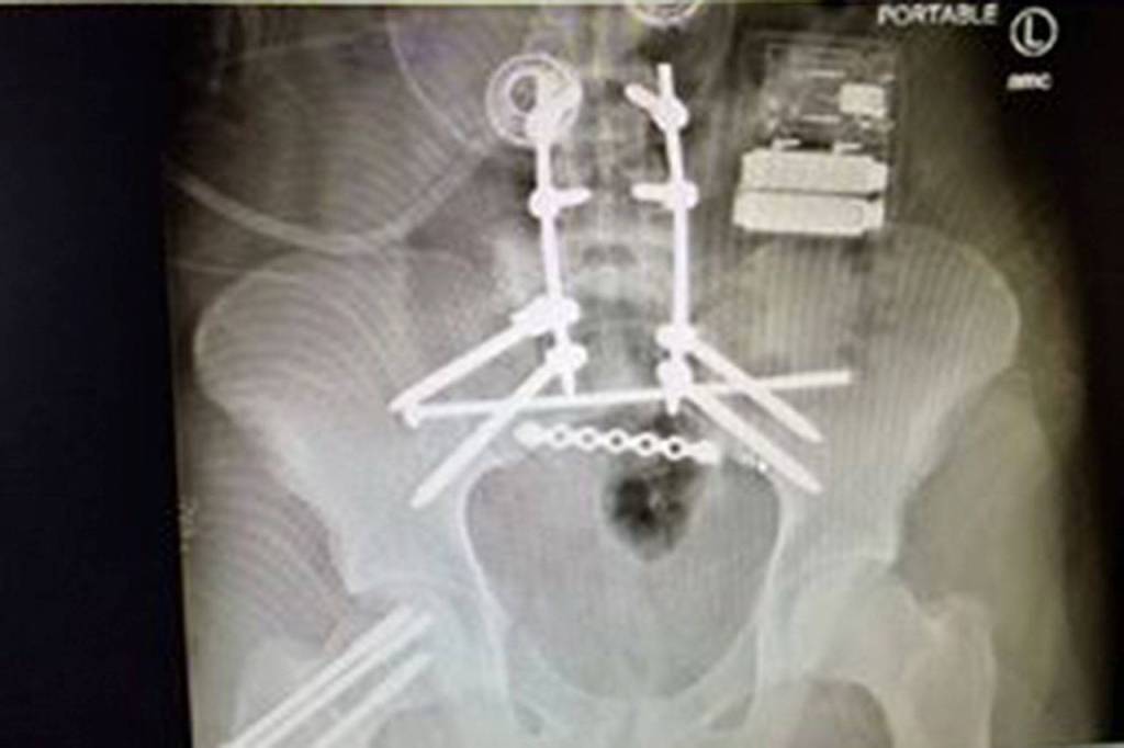 After falling from a bridge, Luke Silliman is receiving treatment at Northwestern Memorial Hospital in Chicago, where he&rsquo;s had two surgeries including 12 screws, two rods and a titanium plate placed into his body.