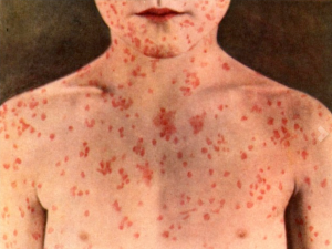 Measles is one of the most contagious infectious diseases. Its rash consists of small red spots